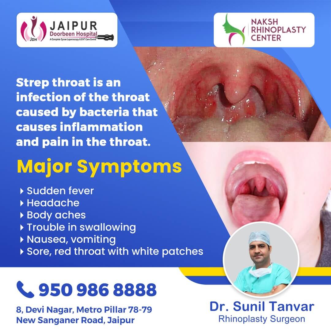 What is Strep Throat & it’s Symptoms